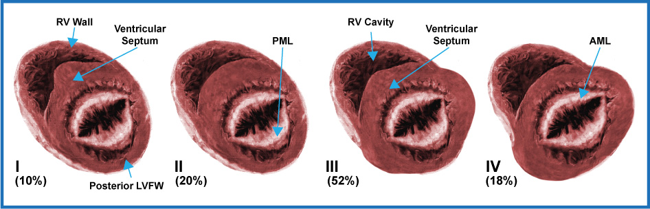 Maron's original classification of hypertrophic cardiomyopathy by 2D echocardiography. Type I to IV. (Modified from Maron BJ et al.)
